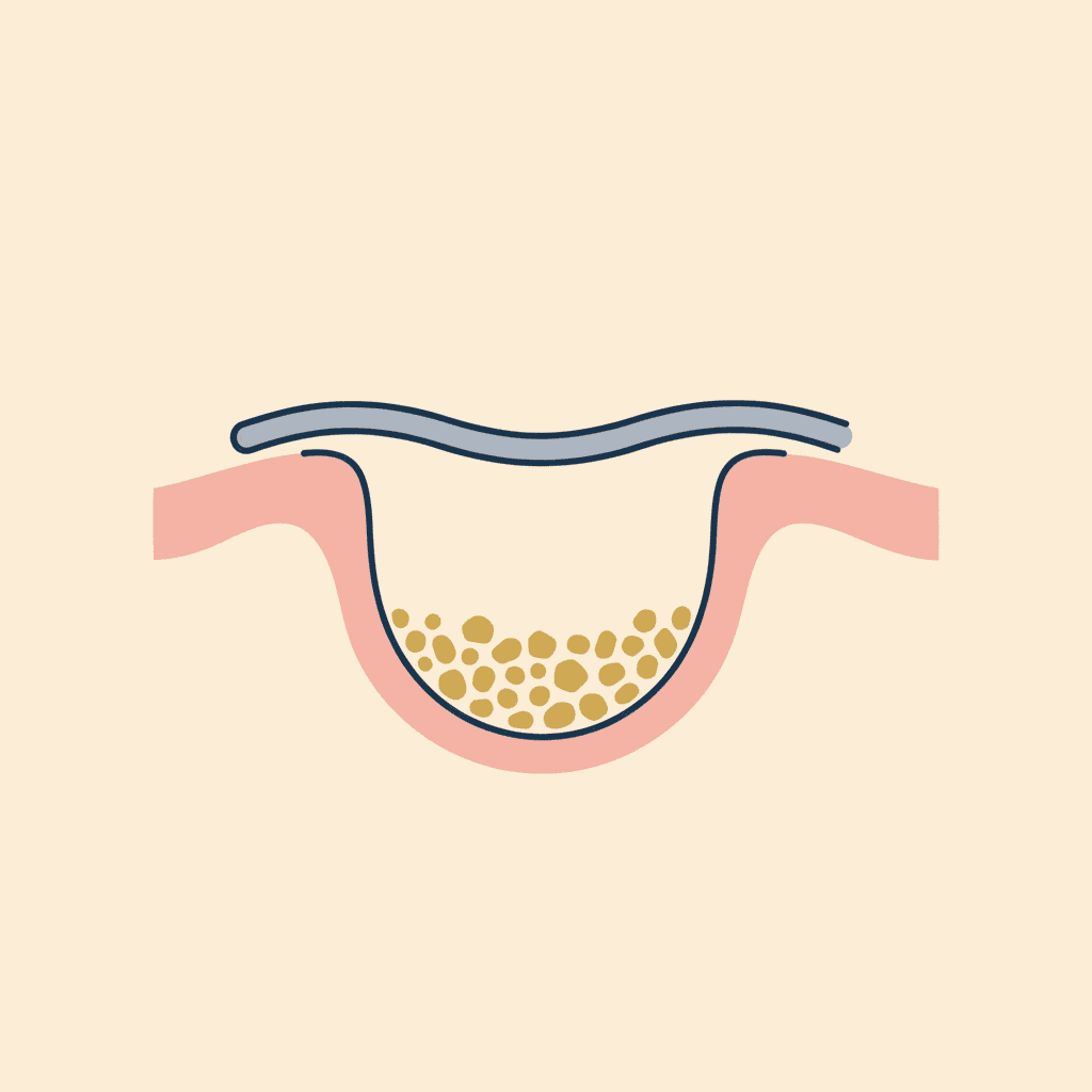 Bone graft filling a tooth socket to prepare for a dental implant, Spring Hope NC