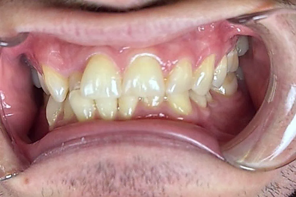 Crowded front teeth before clear aligner treatment at Spring Hope Family Dentistry