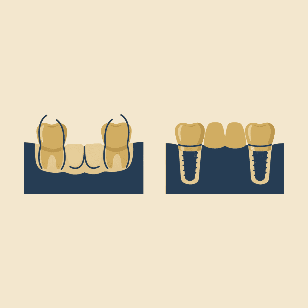 Implant bridge compared to a removable partial denture in Spring Hope NC