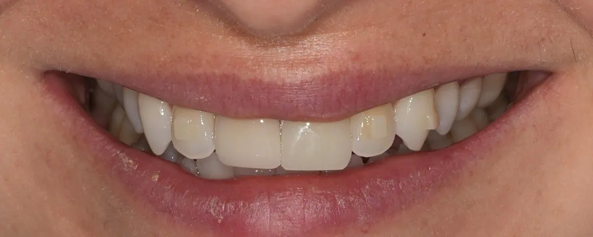Complete smile after a single dental implant at Spring Hope Family Dentistry