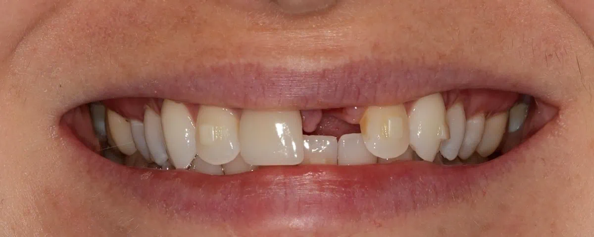 Smile with a missing tooth before a dental implant at Spring Hope Family Dentistry