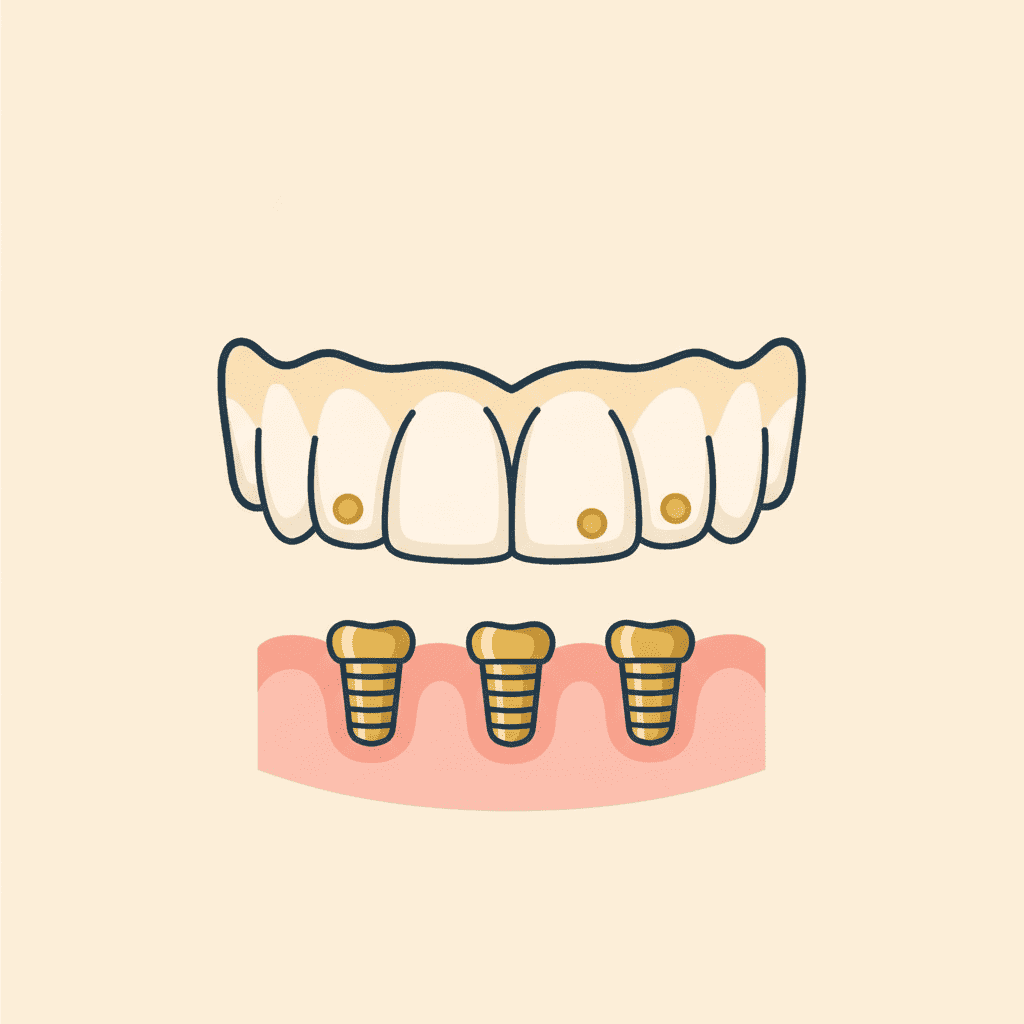 Snap-in implant overdenture on three implants, lower arch, Spring Hope NC