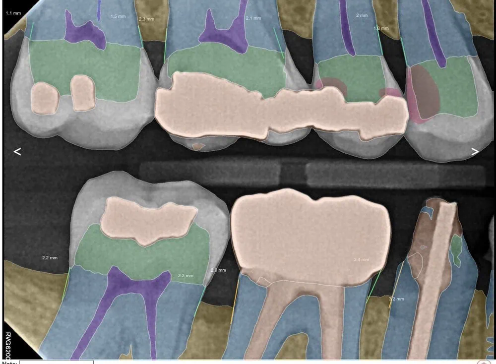 Real patient dental X-ray with AI anatomy overlay at Spring Hope Family Dentistry