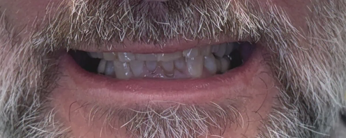 Before full-mouth rehabilitation: worn, discolored smile