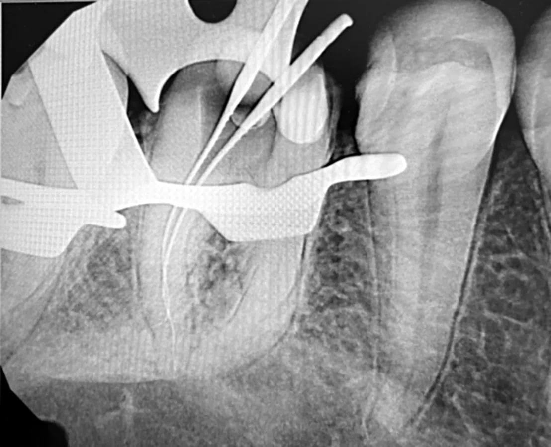 Root canal working length X-ray showing files measured to the ends of a lower molar canal
