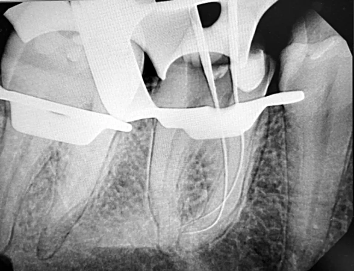 Second working length X-ray confirming each canal of the molar is measured to its end