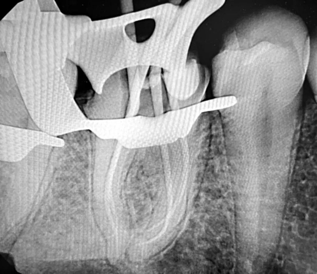 Cone fit X-ray showing gutta-percha points seated in each canal of the molar before sealing