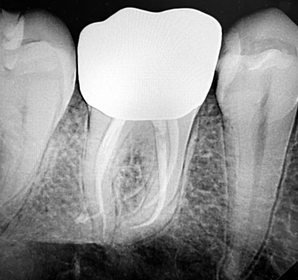 Completed molar root canal with canals sealed to the ends and a porcelain crown in place