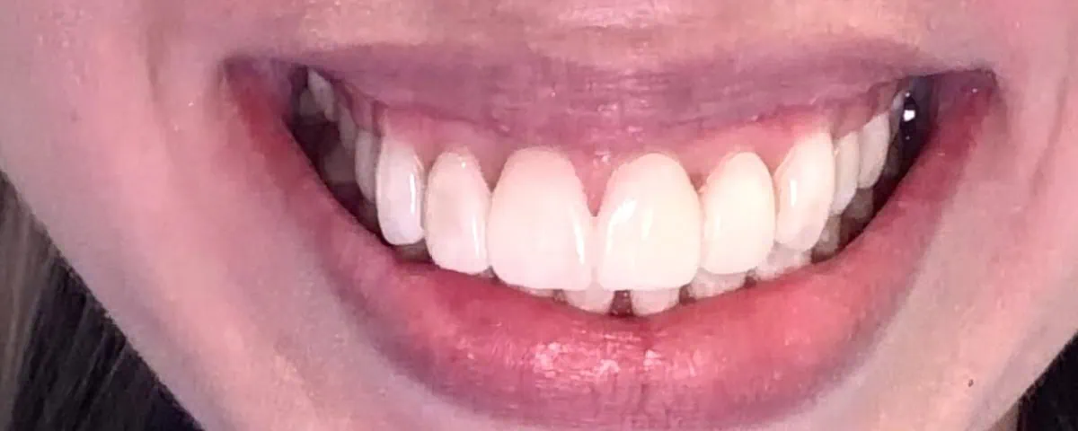 Patient wearing a 3D-printed smile trial at Spring Hope Family Dentistry