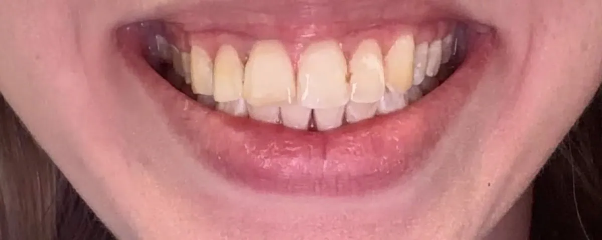 Natural smile before a smile trial at Spring Hope Family Dentistry