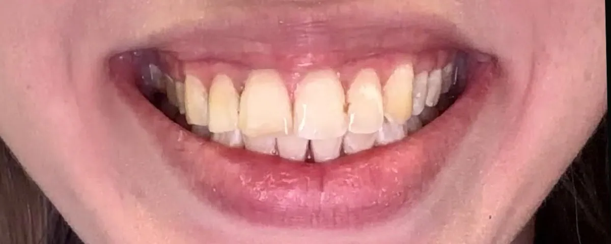 Natural smile before a smile trial at Spring Hope Family Dentistry