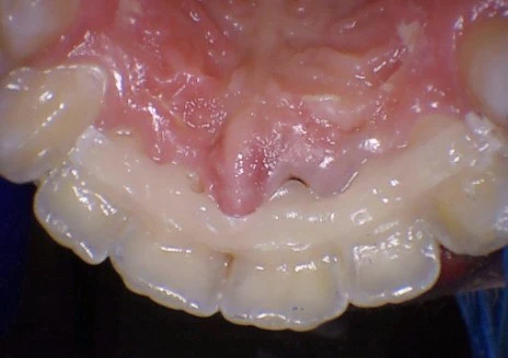 Ribbond fiber splint bonded across the back of the upper front teeth to hold a loose tooth steady