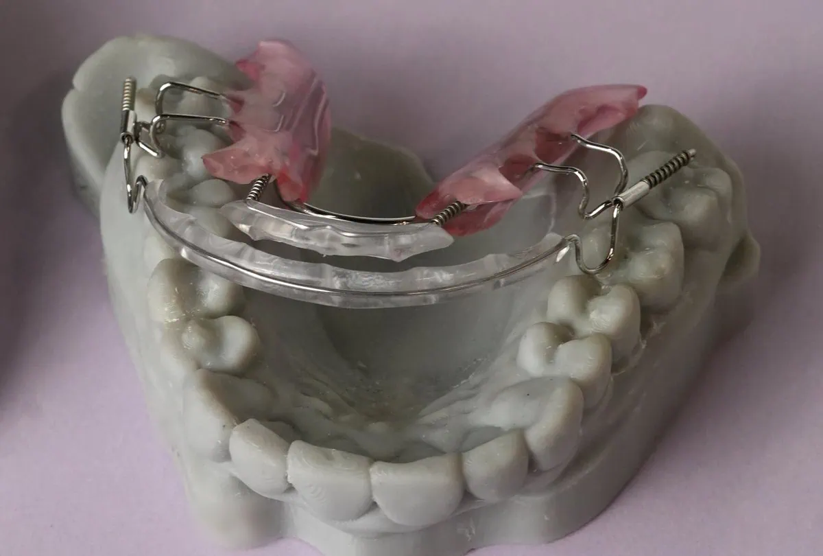 Inman Aligner seated on a model of a patient's upper teeth, seen from behind, with the springs and both bows visible