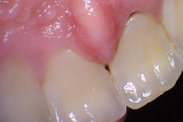 Loose upper front tooth seen from behind, sitting out of line after a dental injury