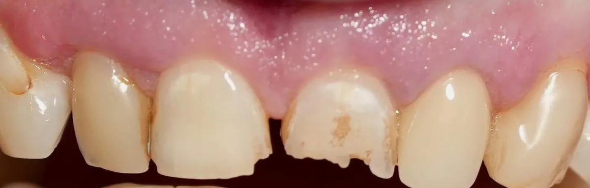 Fractured upper front tooth before treatment at Spring Hope Family Dentistry